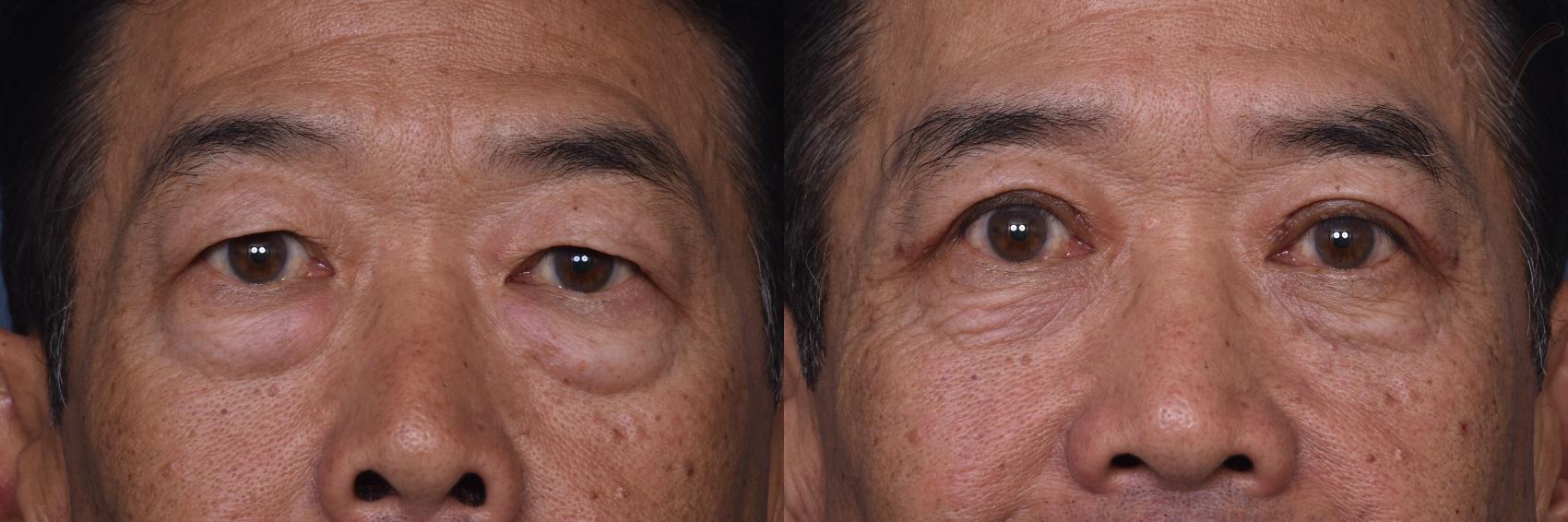 Before & After Combined Upper & Lower Eyelid Surgery Case 440 Front View in Los Angeles, CA