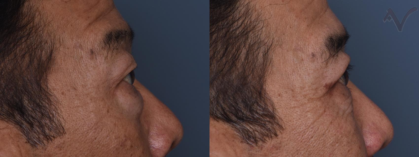 Before & After Combined Upper & Lower Eyelid Surgery Case 440 Right Side View in Los Angeles, CA