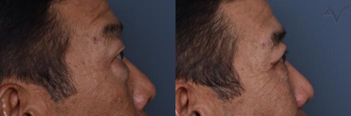 Before & After Combined Upper & Lower Eyelid Surgery Case 440 Right Side View in Los Angeles, CA