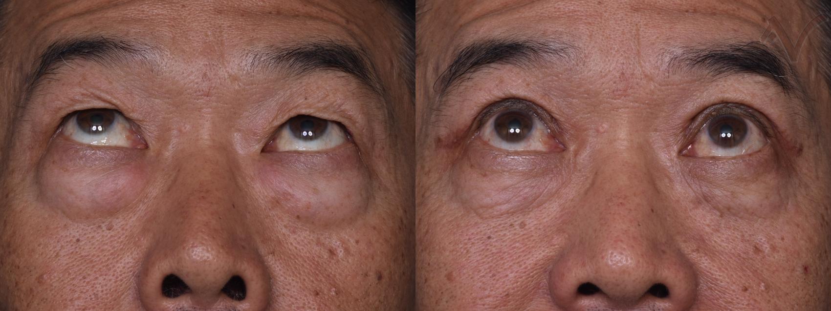 Before & After Combined Upper & Lower Eyelid Surgery Case 440 Upward Gaze View in Los Angeles, CA