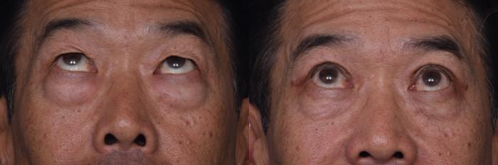 Before & After Combined Upper & Lower Eyelid Surgery Case 440 Upward Gaze View in Los Angeles, CA