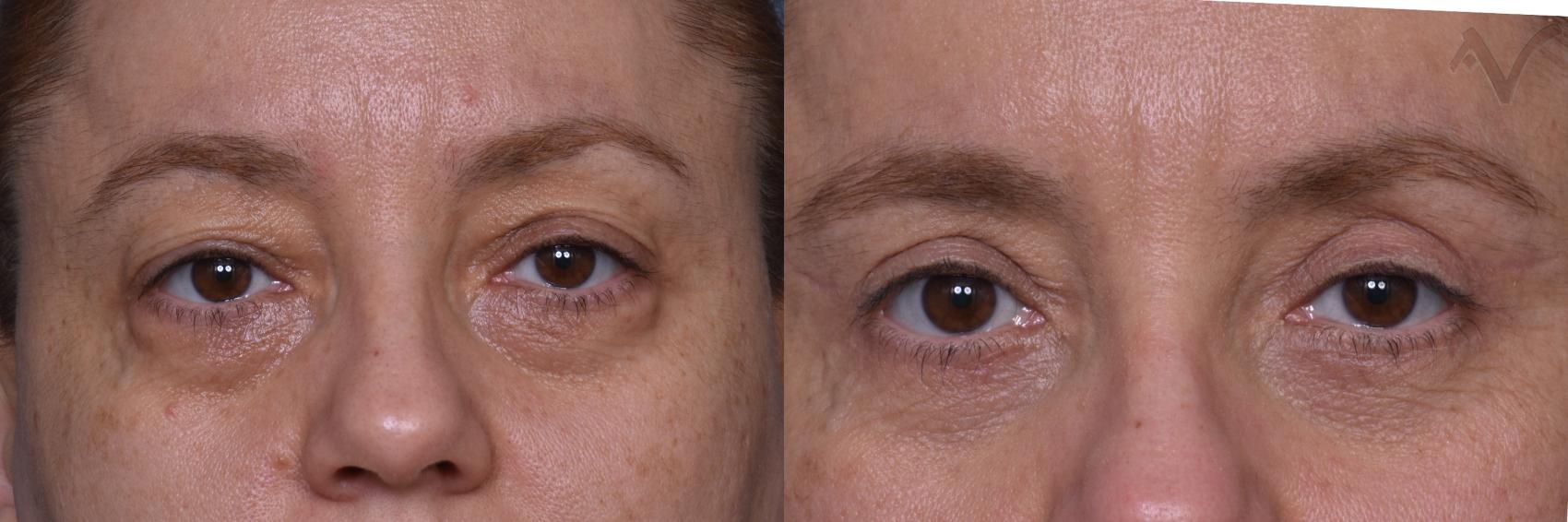 Before & After Combined Upper & Lower Eyelid Surgery Case 443 Front View in Los Angeles, CA