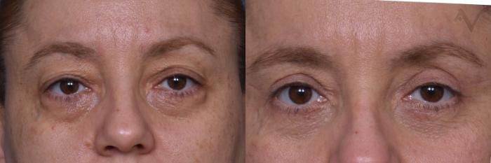 Before & After Combined Upper & Lower Eyelid Surgery Case 443 Front View in Los Angeles, CA