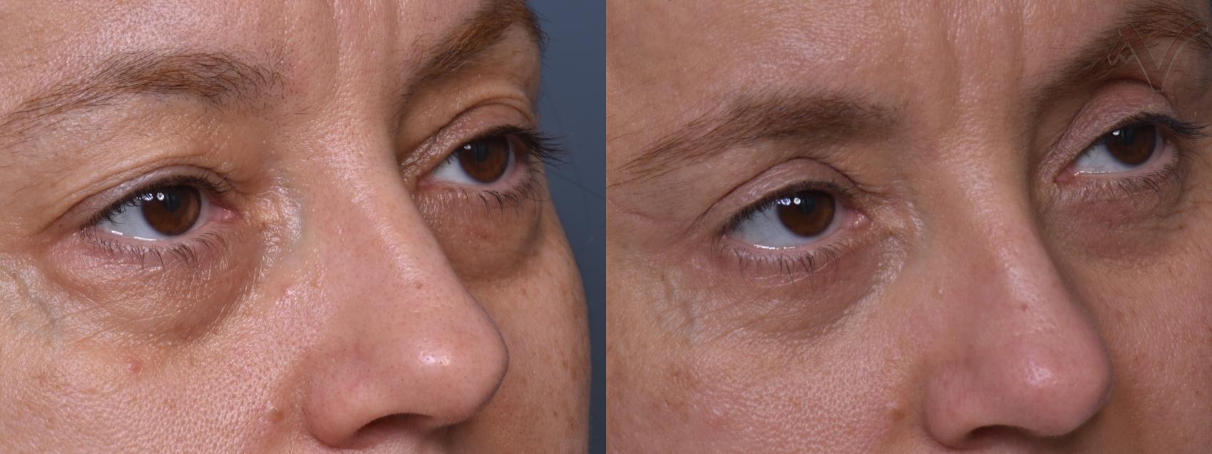 Before & After Combined Upper & Lower Eyelid Surgery Case 443 Right Oblique View in Los Angeles, CA