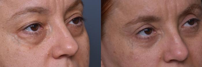 Before & After Combined Upper & Lower Eyelid Surgery Case 443 Right Oblique View in Los Angeles, CA