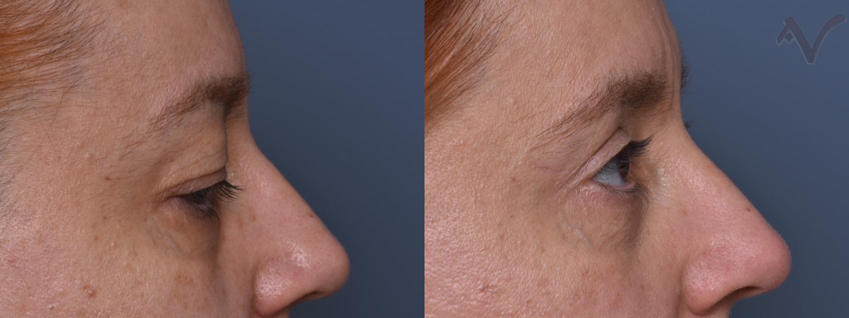 Before & After Combined Upper & Lower Eyelid Surgery Case 443 Right Side View in Los Angeles, CA