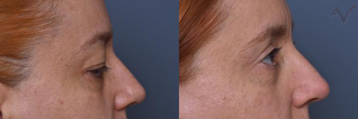 Before & After Combined Upper & Lower Eyelid Surgery Case 443 Right Side View in Los Angeles, CA