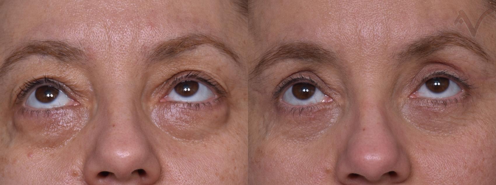 Before & After Combined Upper & Lower Eyelid Surgery Case 443 Upward Gaze View in Los Angeles, CA