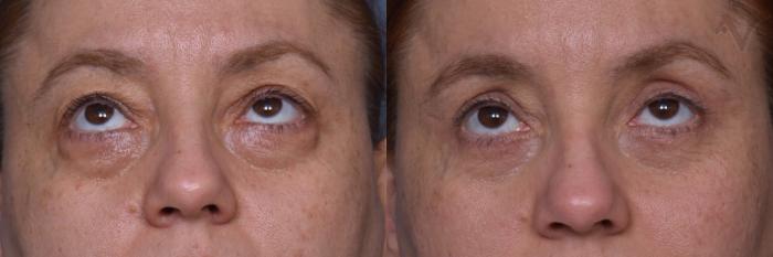 Before & After Combined Upper & Lower Eyelid Surgery Case 443 Upward Gaze View in Los Angeles, CA