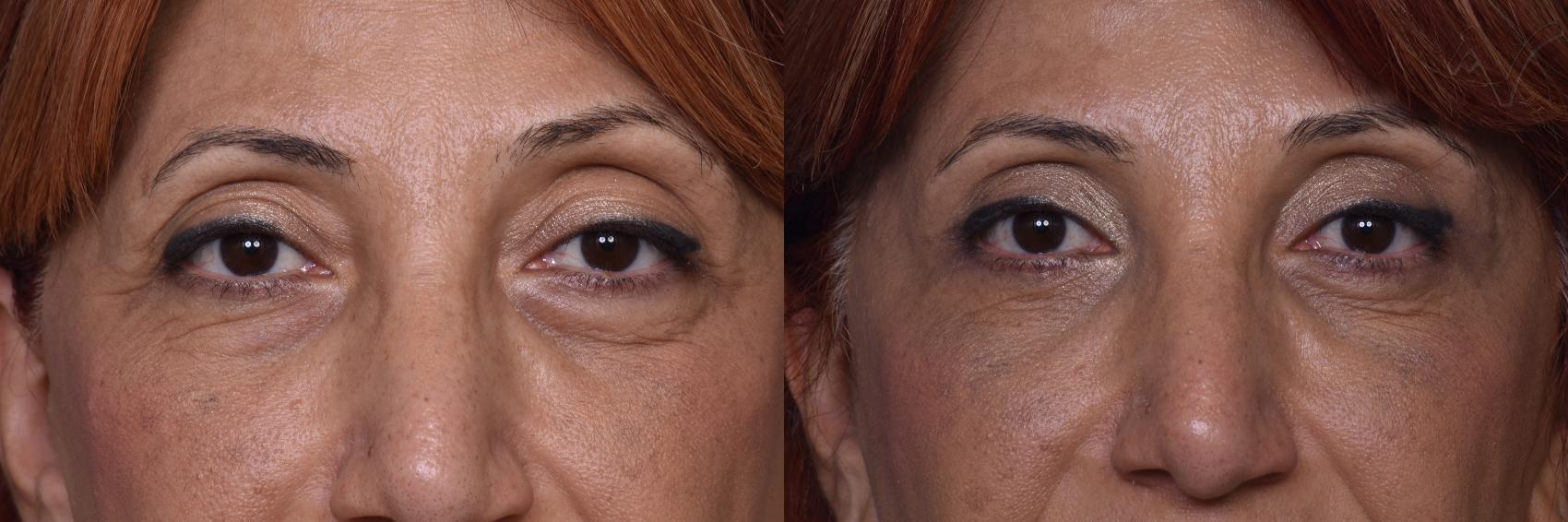 Before & After Combined Upper & Lower Eyelid Surgery Case 444 Front View in Los Angeles, CA