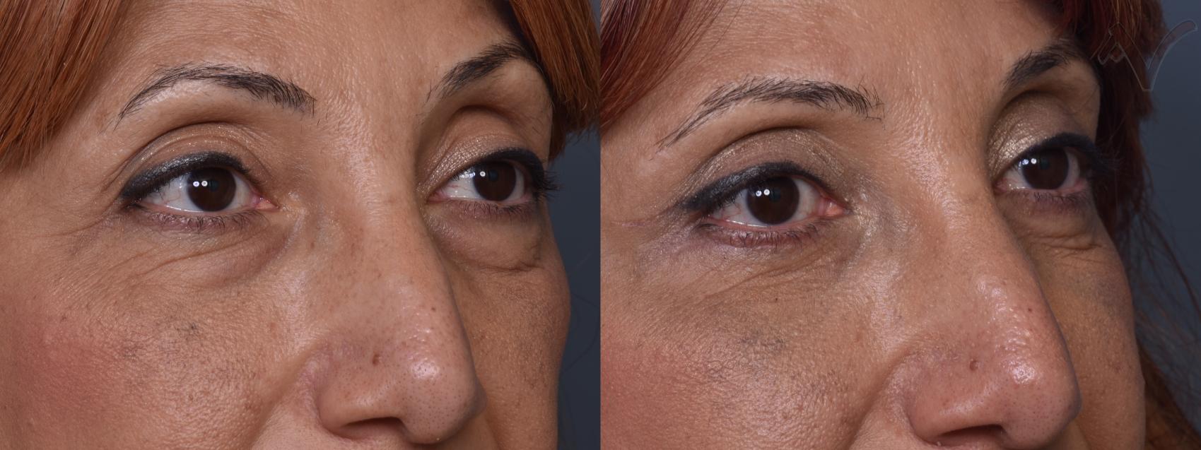 Before & After Combined Upper & Lower Eyelid Surgery Case 444 Right Oblique View in Los Angeles, CA