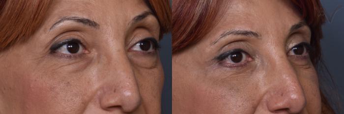 Before & After Combined Upper & Lower Eyelid Surgery Case 444 Right Oblique View in Los Angeles, CA