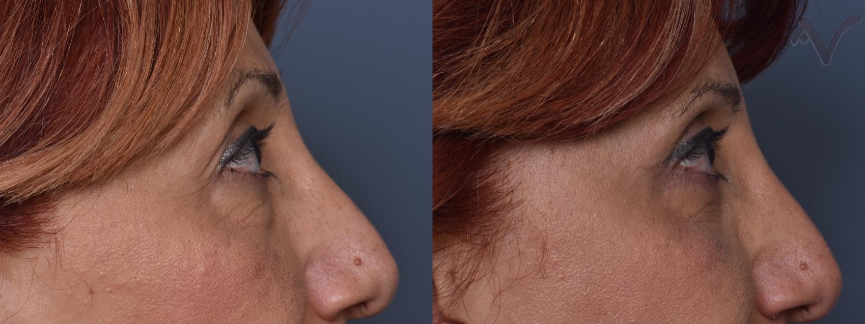 Before & After Combined Upper & Lower Eyelid Surgery Case 444 Right Side View in Los Angeles, CA