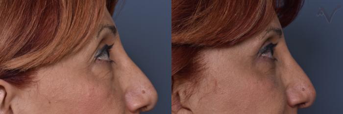 Before & After Combined Upper & Lower Eyelid Surgery Case 444 Right Side View in Los Angeles, CA