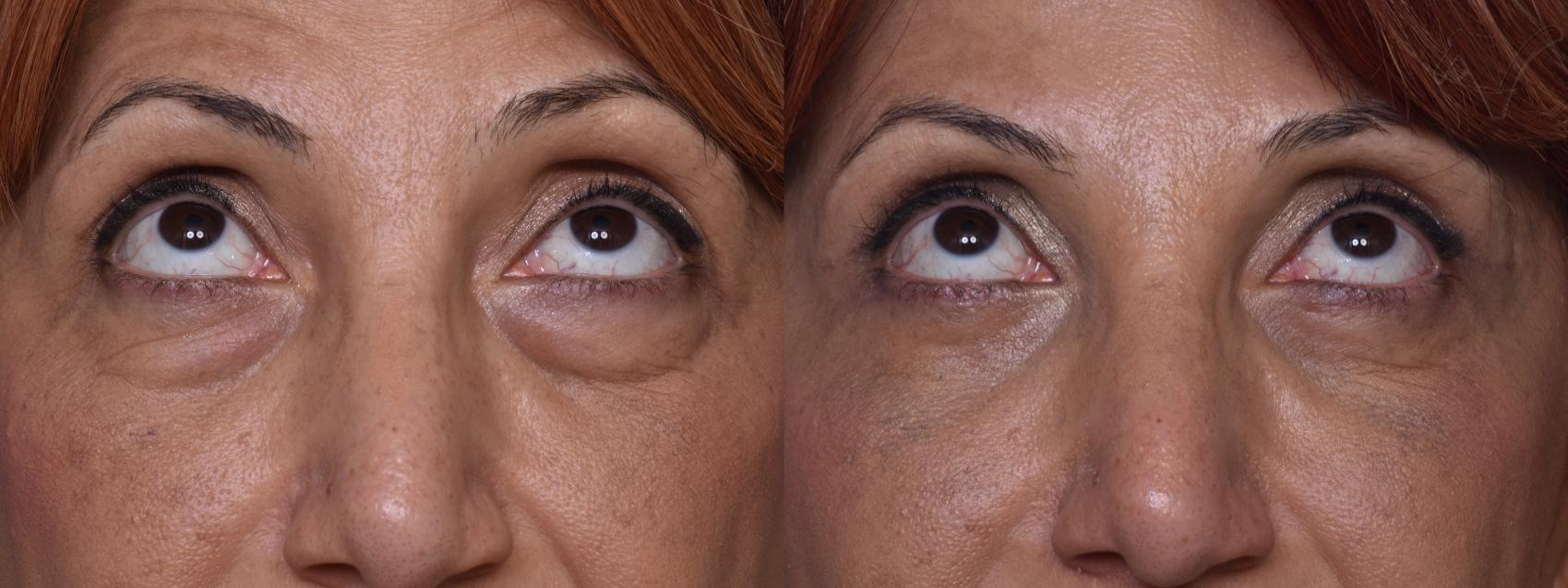 Before & After Combined Upper & Lower Eyelid Surgery Case 444 Upward Gaze View in Los Angeles, CA