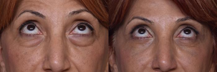Before & After Combined Upper & Lower Eyelid Surgery Case 444 Upward Gaze View in Los Angeles, CA