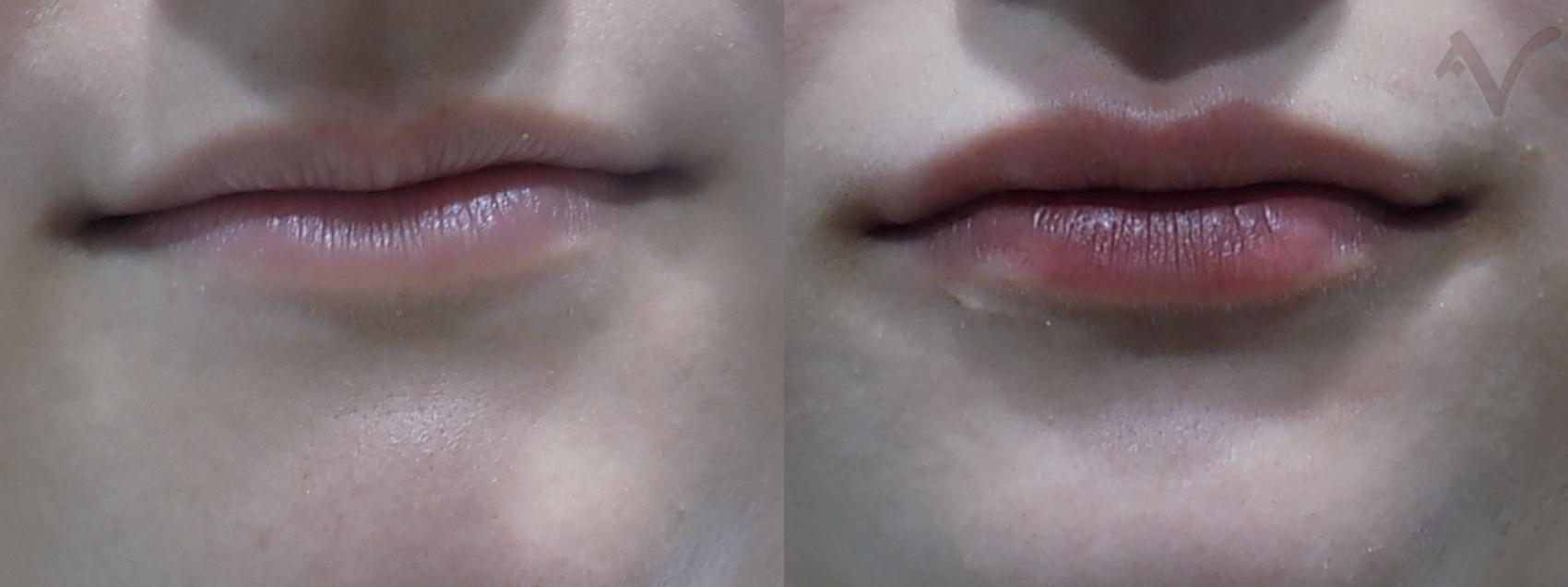Before & After Dermal Fillers Case 20 Front View in Los Angeles, CA