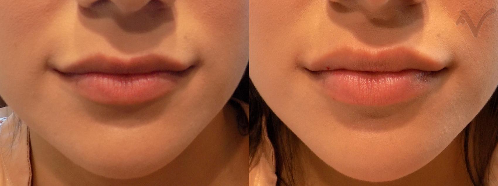 Before & After Dermal Fillers Case 21 Front View in Los Angeles, CA