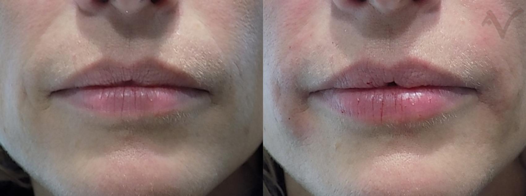 Before & After Dermal Fillers Case 22 Front View in Los Angeles, CA