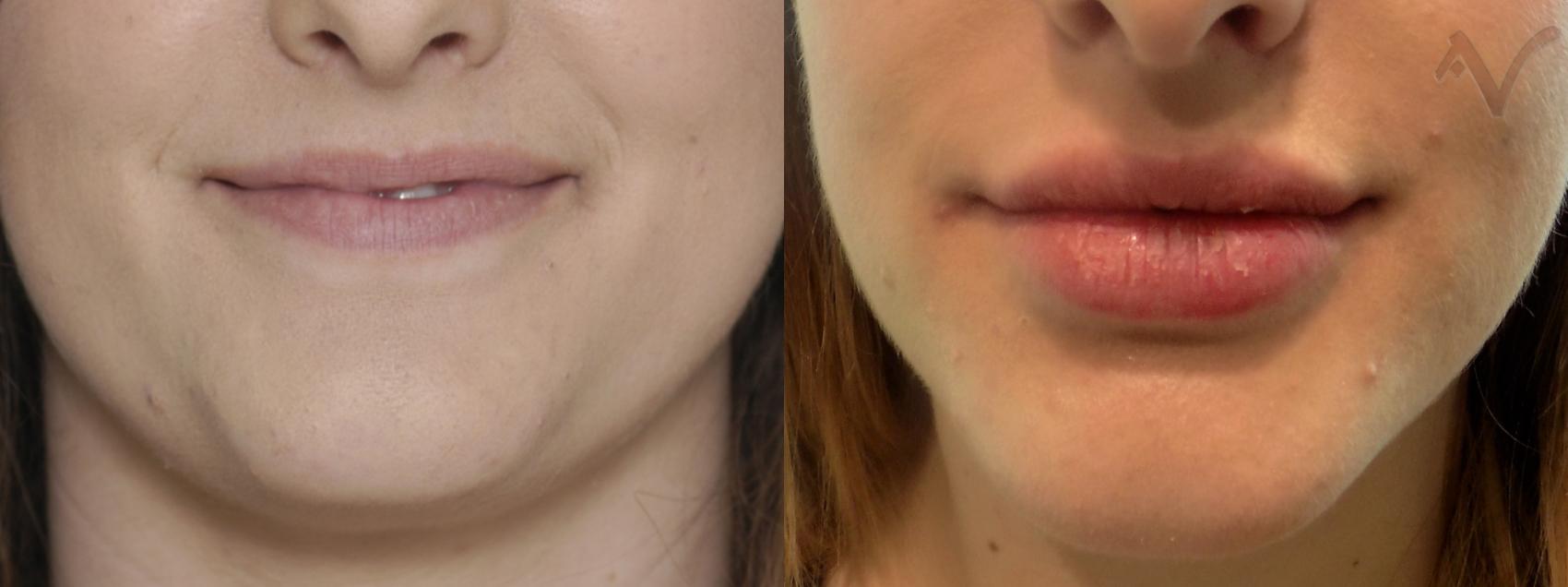 Before & After Dermal Fillers Case 23 Front View in Los Angeles, CA