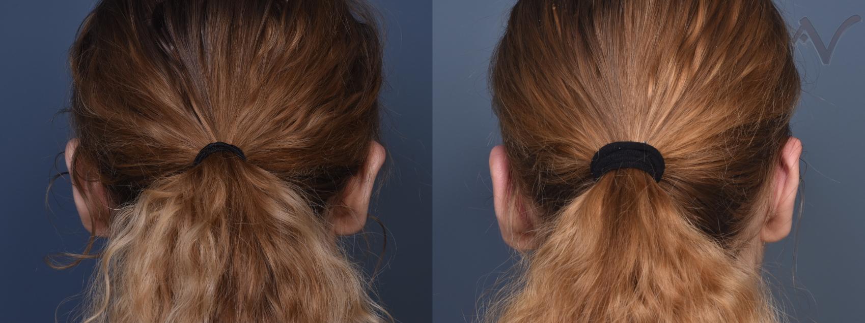 Before & After Ear Surgery Case 465 Back View in Los Angeles, CA