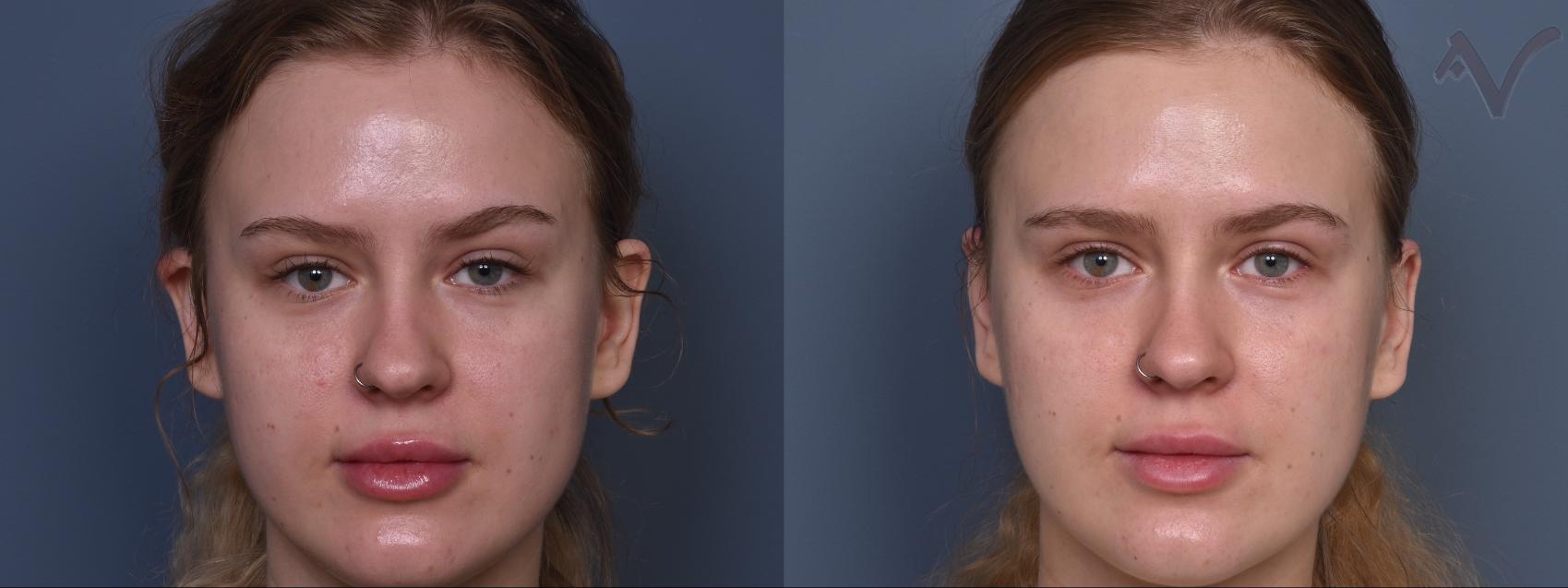 Before & After Ear Surgery Case 465 Front View in Los Angeles, CA