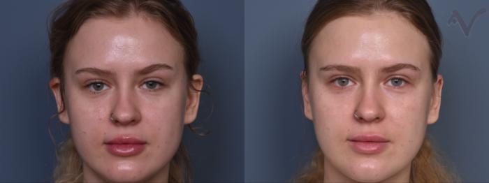 Before & After Ear Surgery Case 465 Front View in Los Angeles, CA