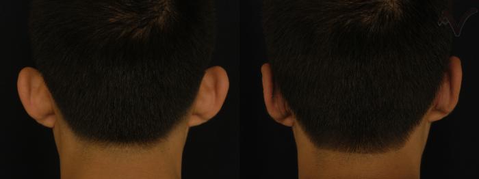 Before & After Ear Surgery Case 91 Back View in Los Angeles, CA