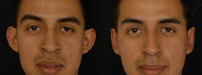 Before & After Ear Surgery Case 91 Front View in Los Angeles, CA