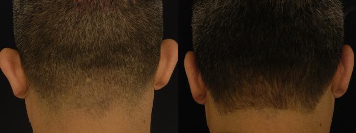 Before & After Ear Surgery Case 92 Back View in Los Angeles, CA
