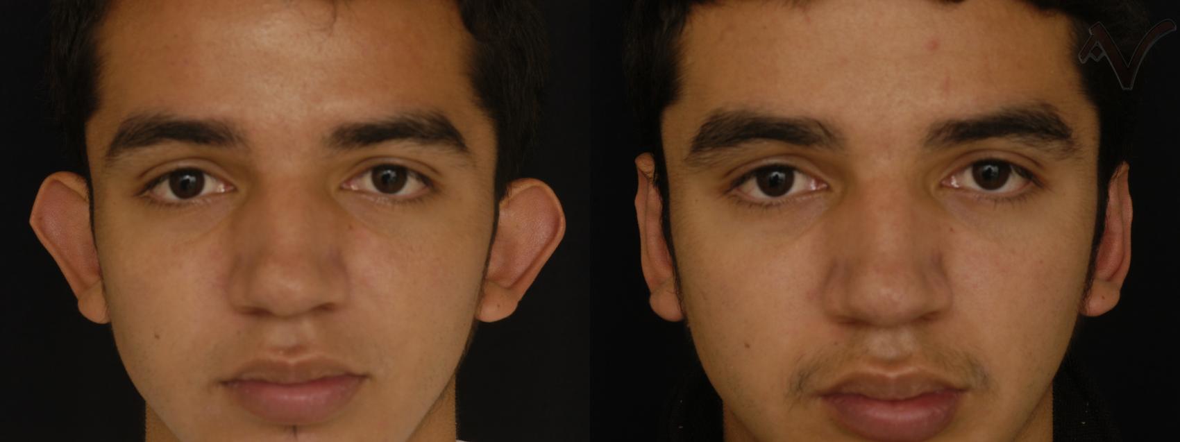 Before & After Ear Surgery Case 93 Front View in Los Angeles, CA