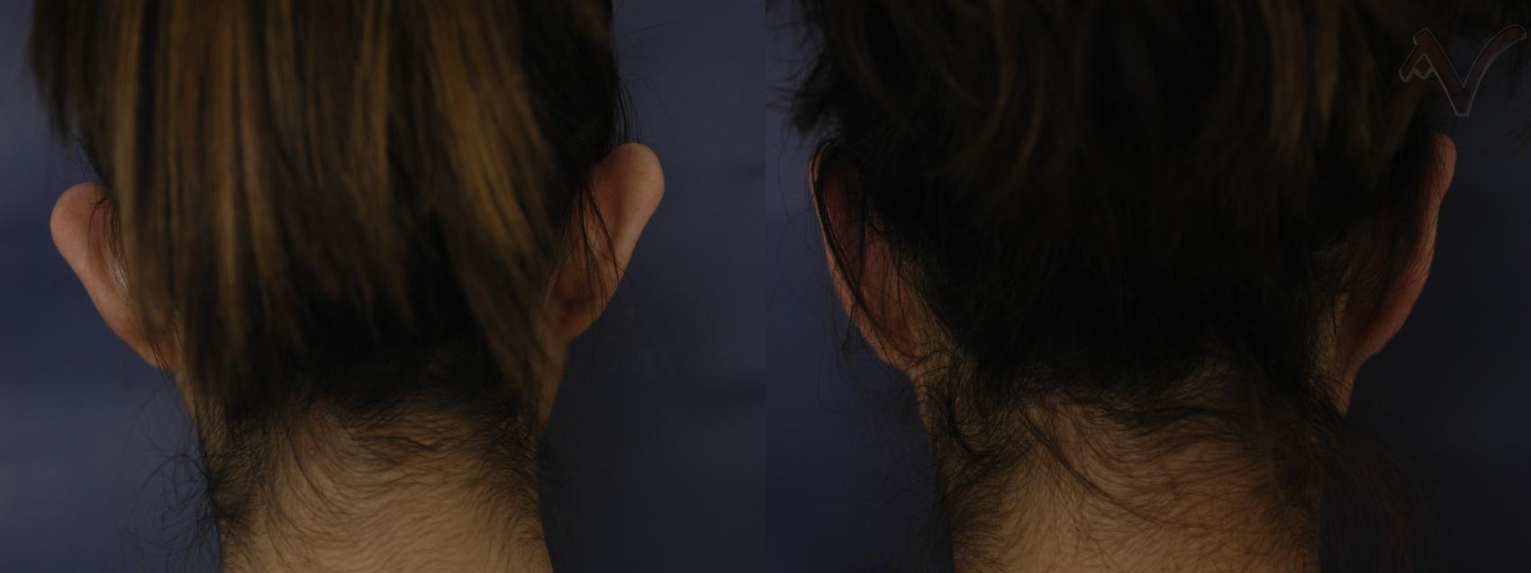 Before & After Ear Surgery Case 97 Back View in Los Angeles, CA