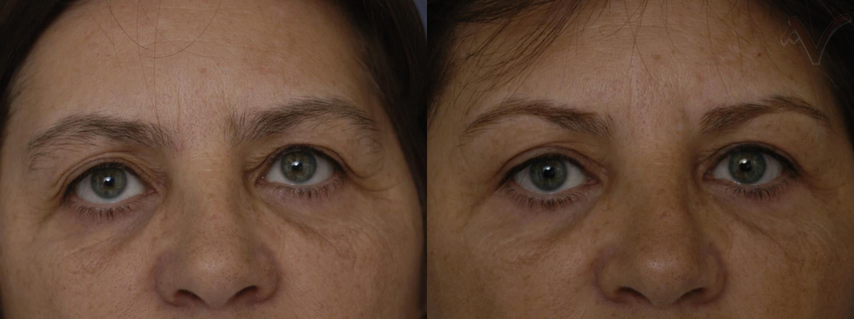 Before & After Eyelid Surgery Case 243 Front View in Burbank, CA