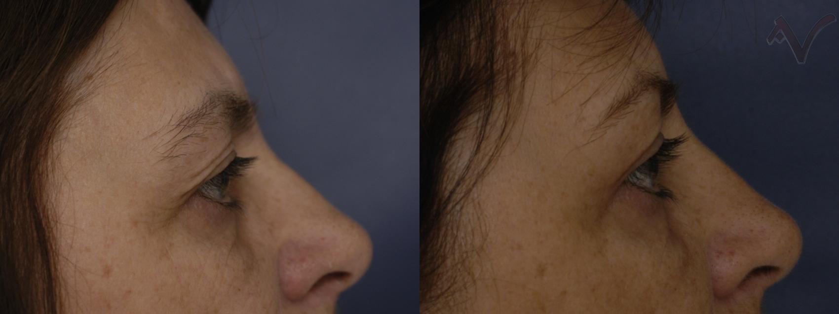 Before & After Eyelid Surgery Case 243 Right Side View in Burbank, CA