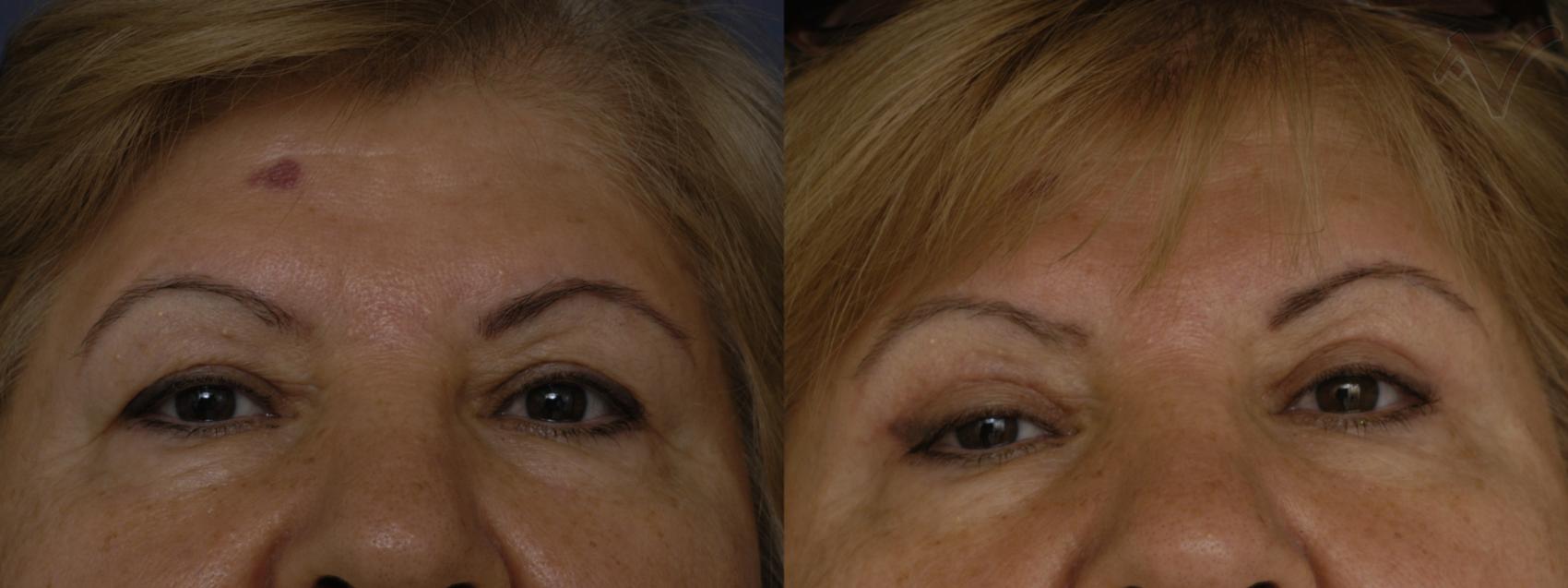 Before & After Eyelid Surgery Case 253 Front View in Los Angeles, CA