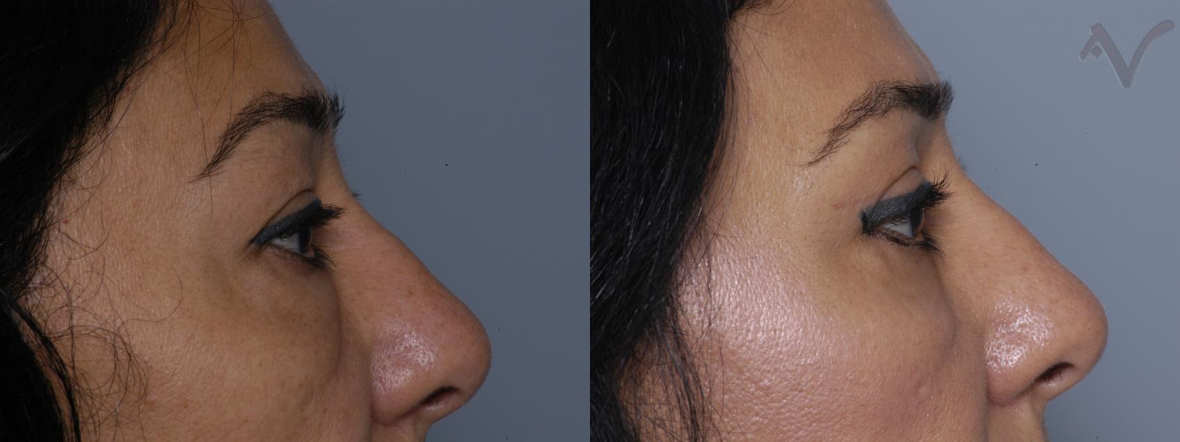 Before & After Eyelid Surgery Case 266 Right Side View in Burbank, CA