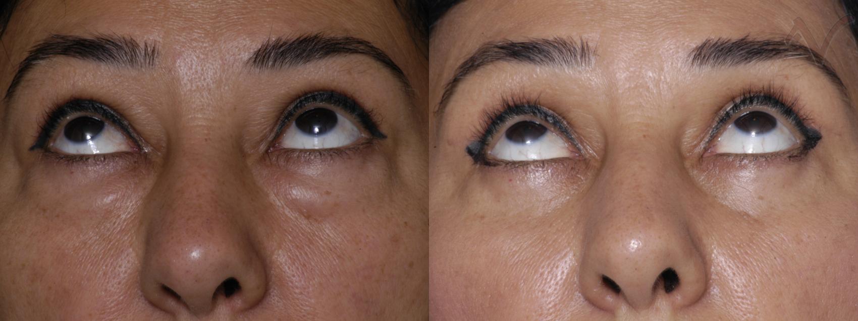 Before & After Eyelid Surgery Case 266 Upward Look View in Burbank, CA
