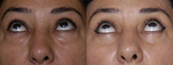 Before & After Combined Upper & Lower Eyelid Surgery Case 266 Upward Look View in Los Angeles, CA