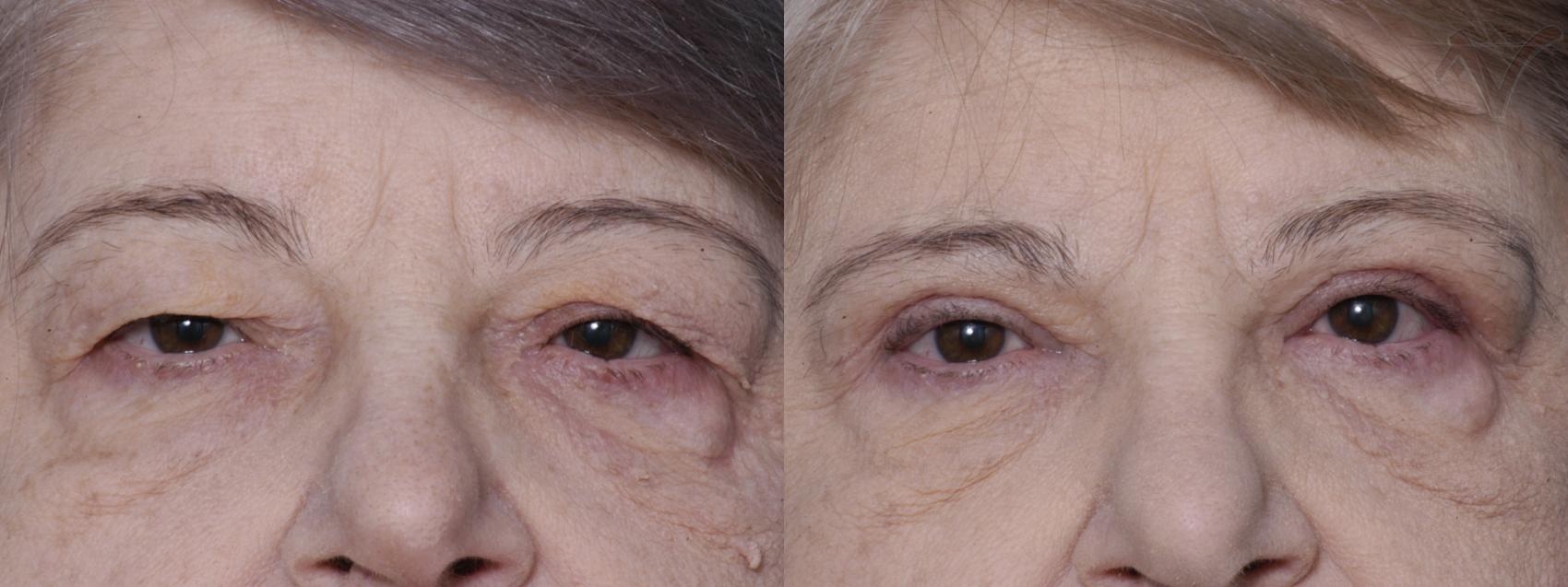 Before & After Eyelid Surgery Case 269 Front View in Burbank, CA