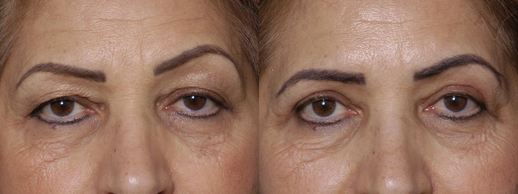Before & After Eyelid Surgery Case 276 Front View in Burbank, CA