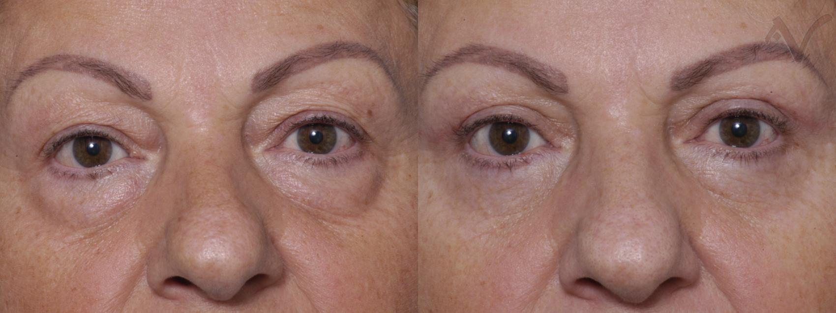 Before & After Eyelid Surgery Case 278 Front View in Los Angeles, CA