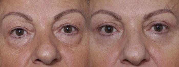 Before & After Combined Upper & Lower Eyelid Surgery Case 278 Front View in Los Angeles, CA