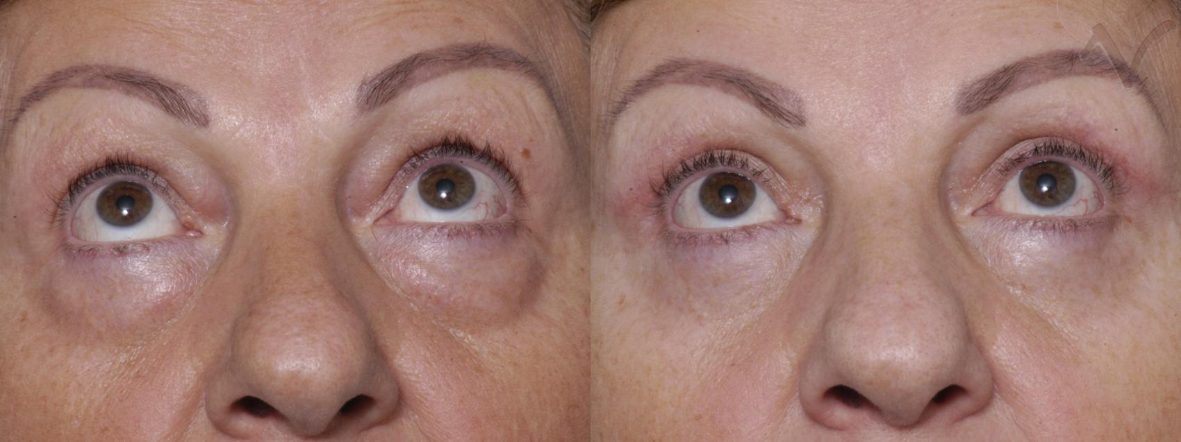 Before & After Eyelid Surgery Case 278 Upward Look View in Burbank, CA