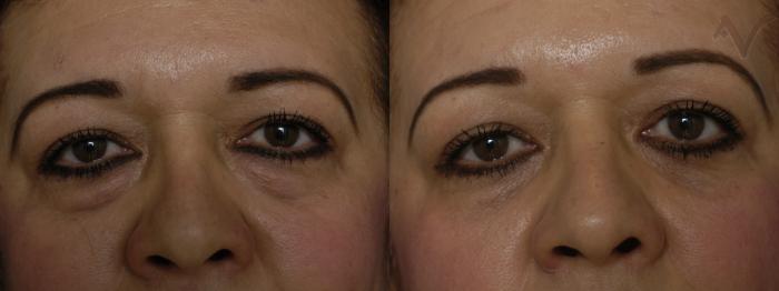 Before & After Eyelid Surgery Case 285 Front View in Los Angeles, CA