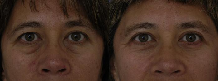 Before & After Combined Upper & Lower Eyelid Surgery Case 286 Front View in Los Angeles, CA