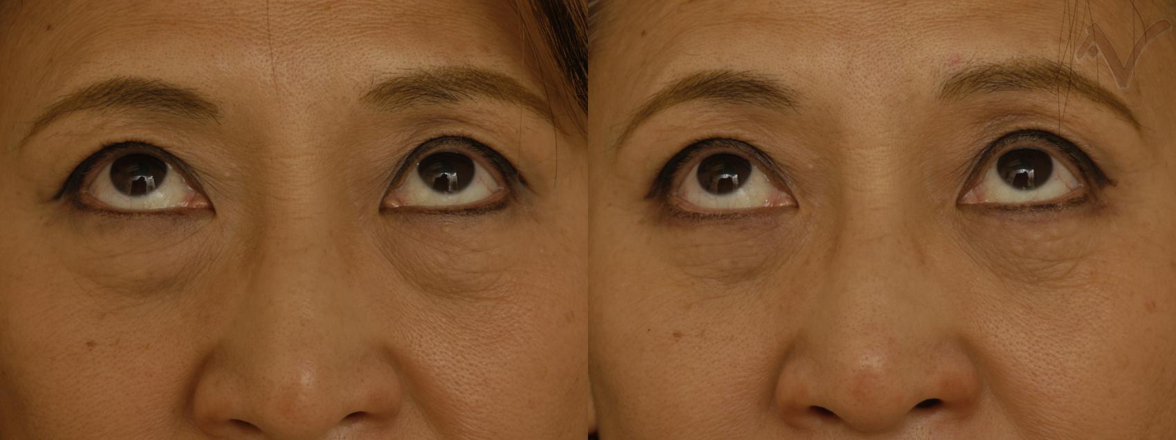 Before & After Eyelid Surgery Case 287 Upward Look View in Burbank, CA