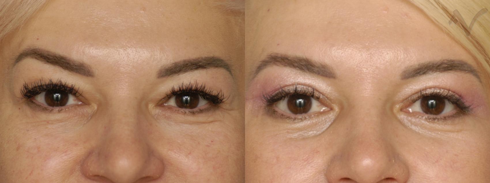 Before & After Eyelid Surgery Case 290 Front View in Burbank, CA