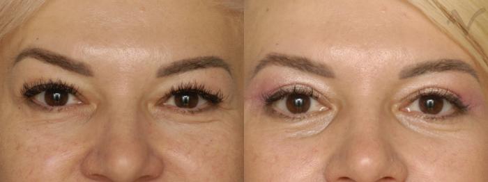 Before & After Combined Upper & Lower Eyelid Surgery Case 290 Front View in Los Angeles, CA