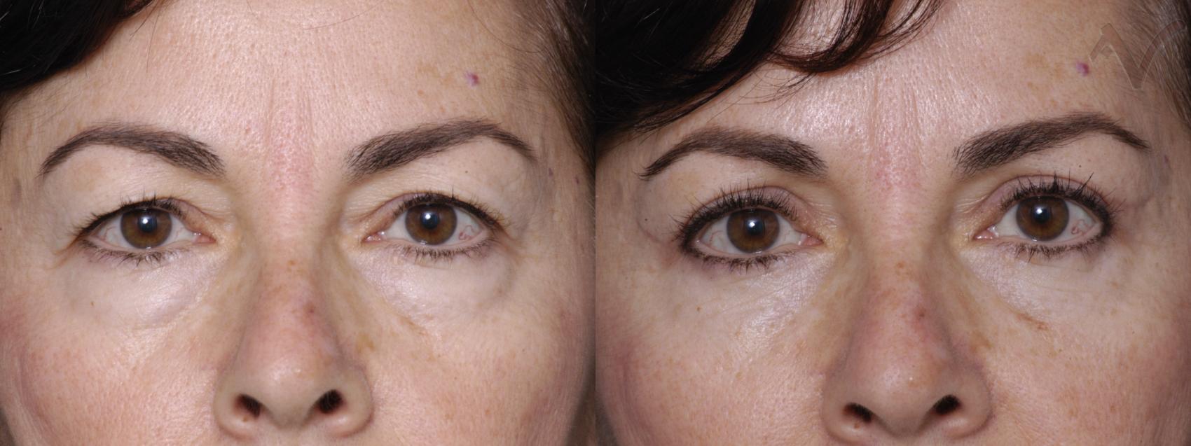 Before & After Combined Upper & Lower Eyelid Surgery Case 291 Front View in Los Angeles, CA