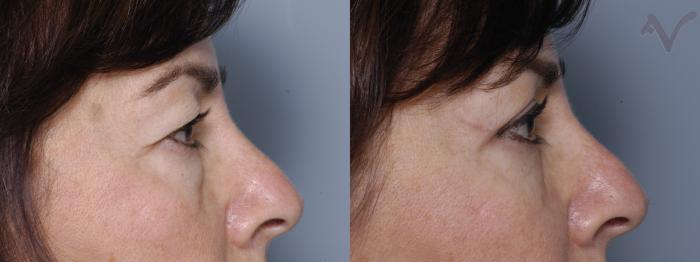 Before & After Combined Upper & Lower Eyelid Surgery Case 291 Right Side View in Los Angeles, CA
